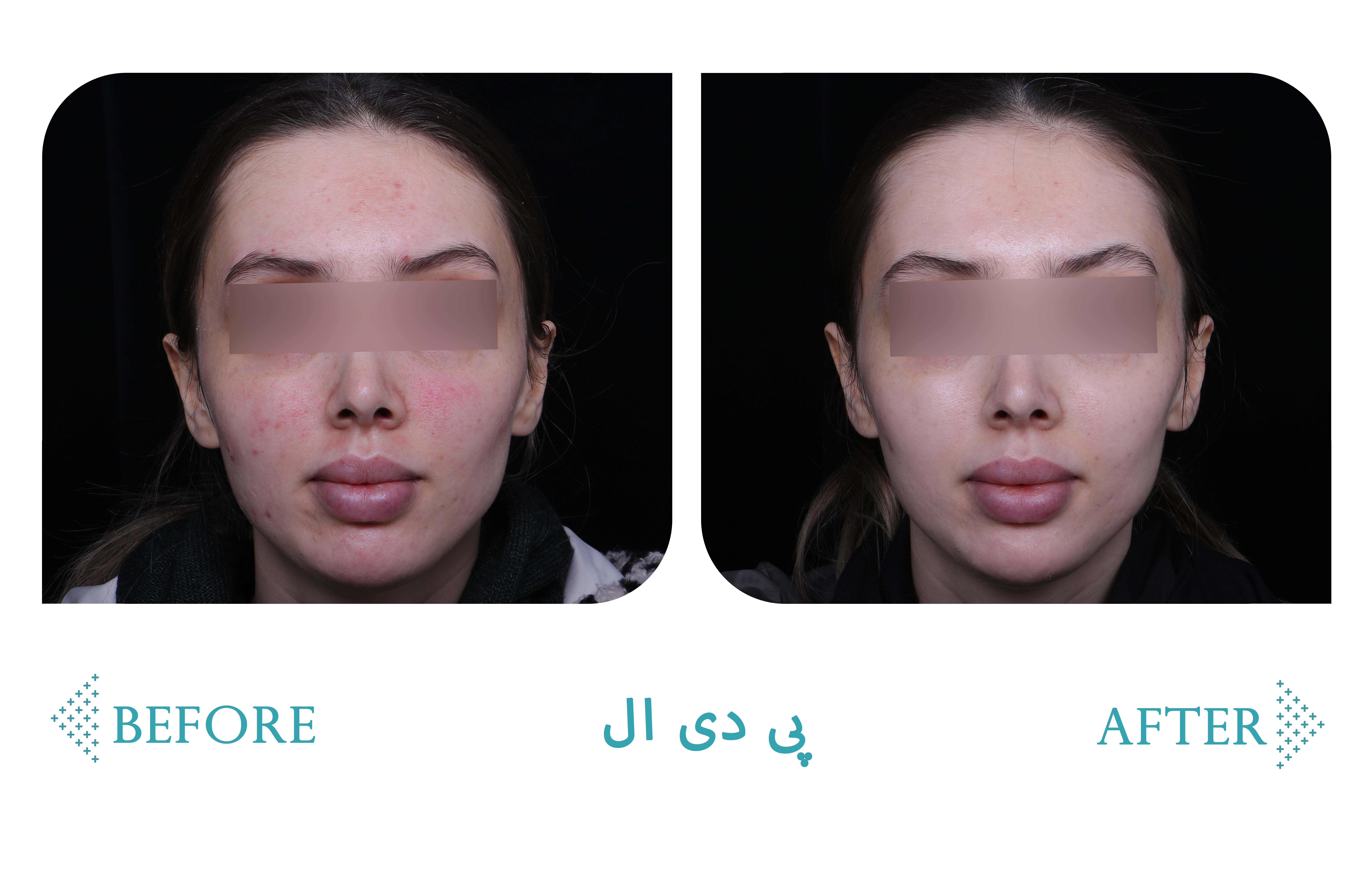 پی دی ال (PDL) — کلینیک شادی کرج