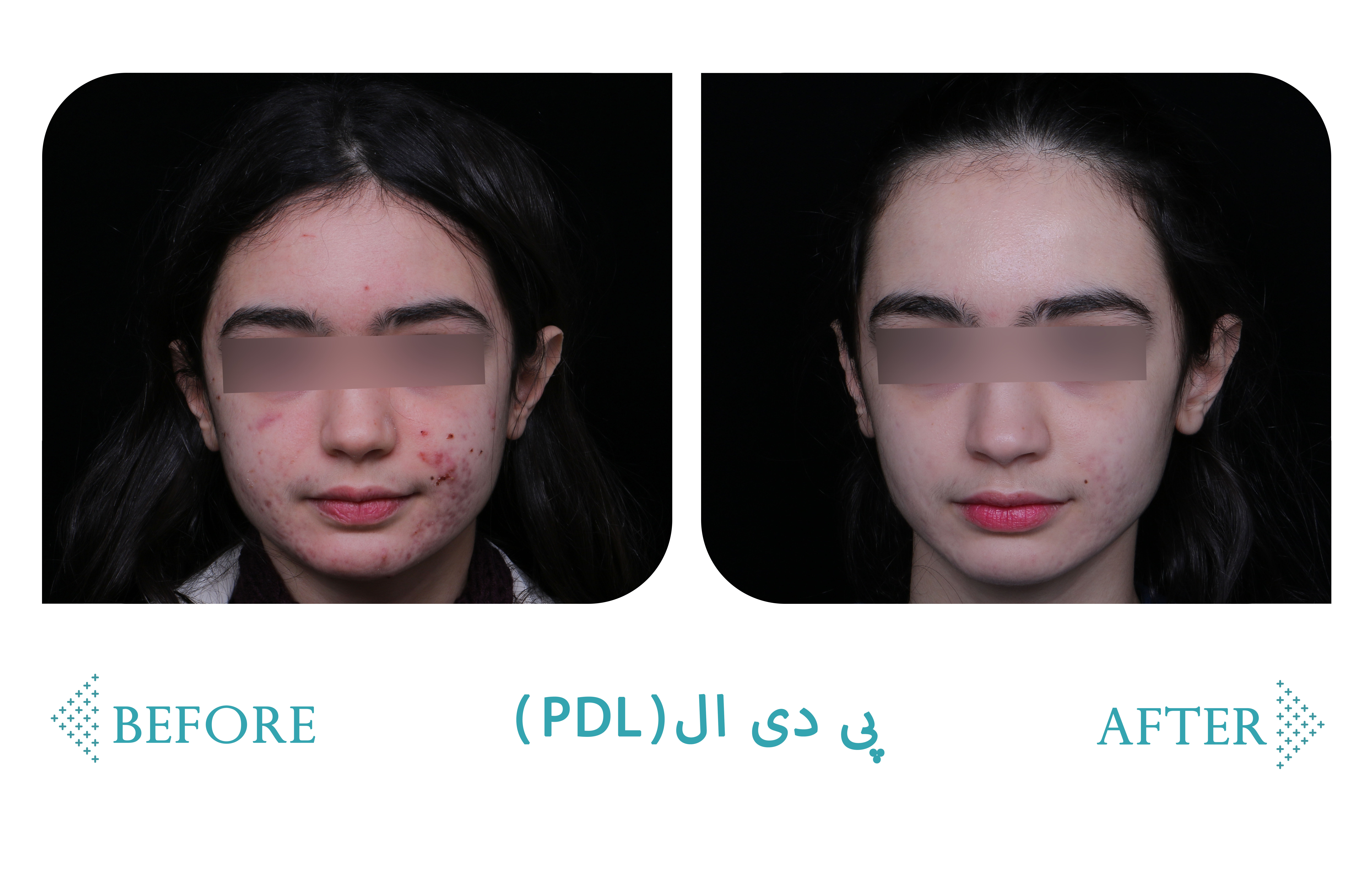پی دی ال (PDL) — کلینیک شادی کرج