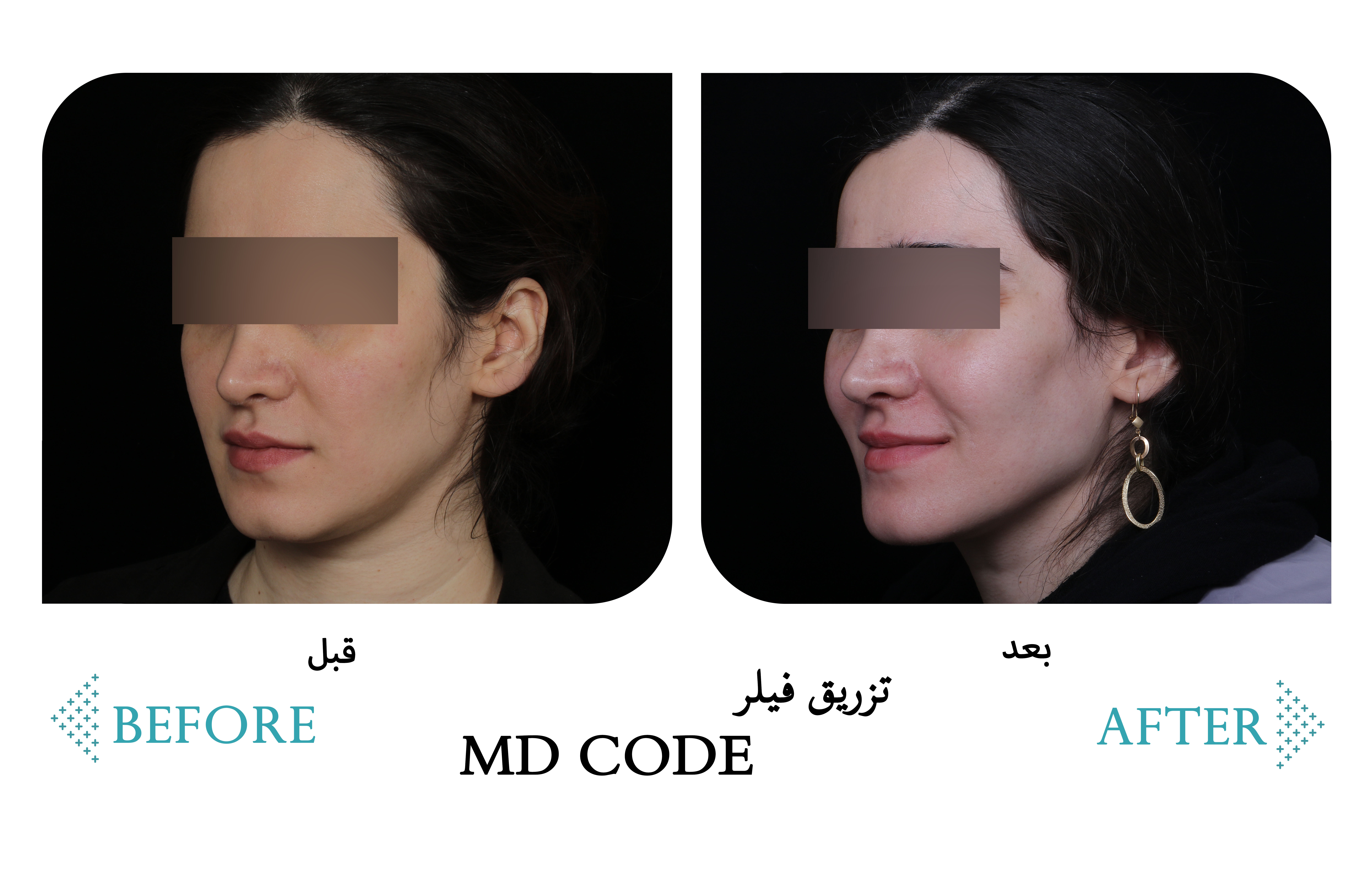 تزریق فیلر MD CODE — کلینیک شادی کرج