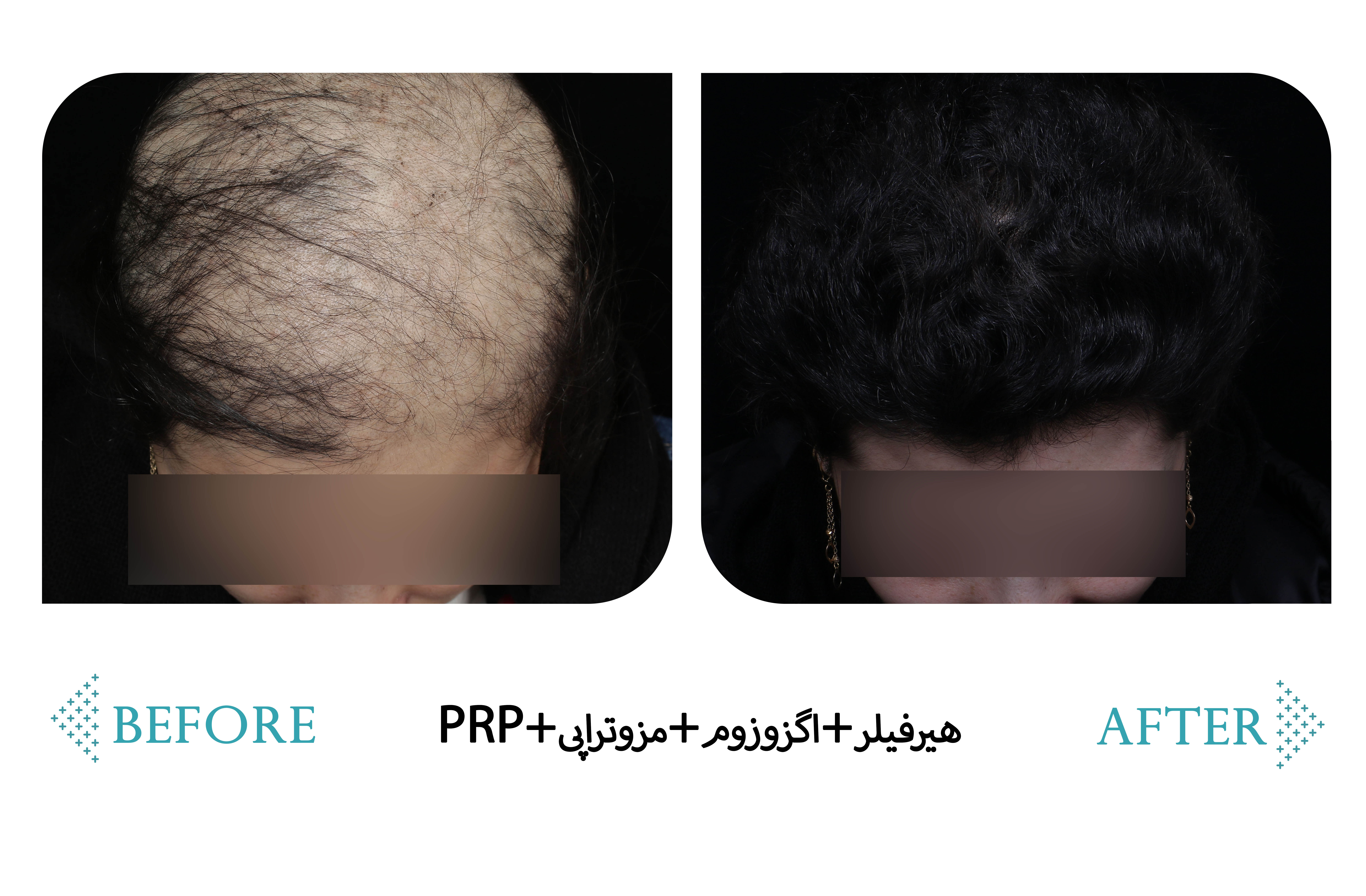 هیرفیلر+مزوتراپی+اگزوزوم+PRP — کلینیک شادی کرج