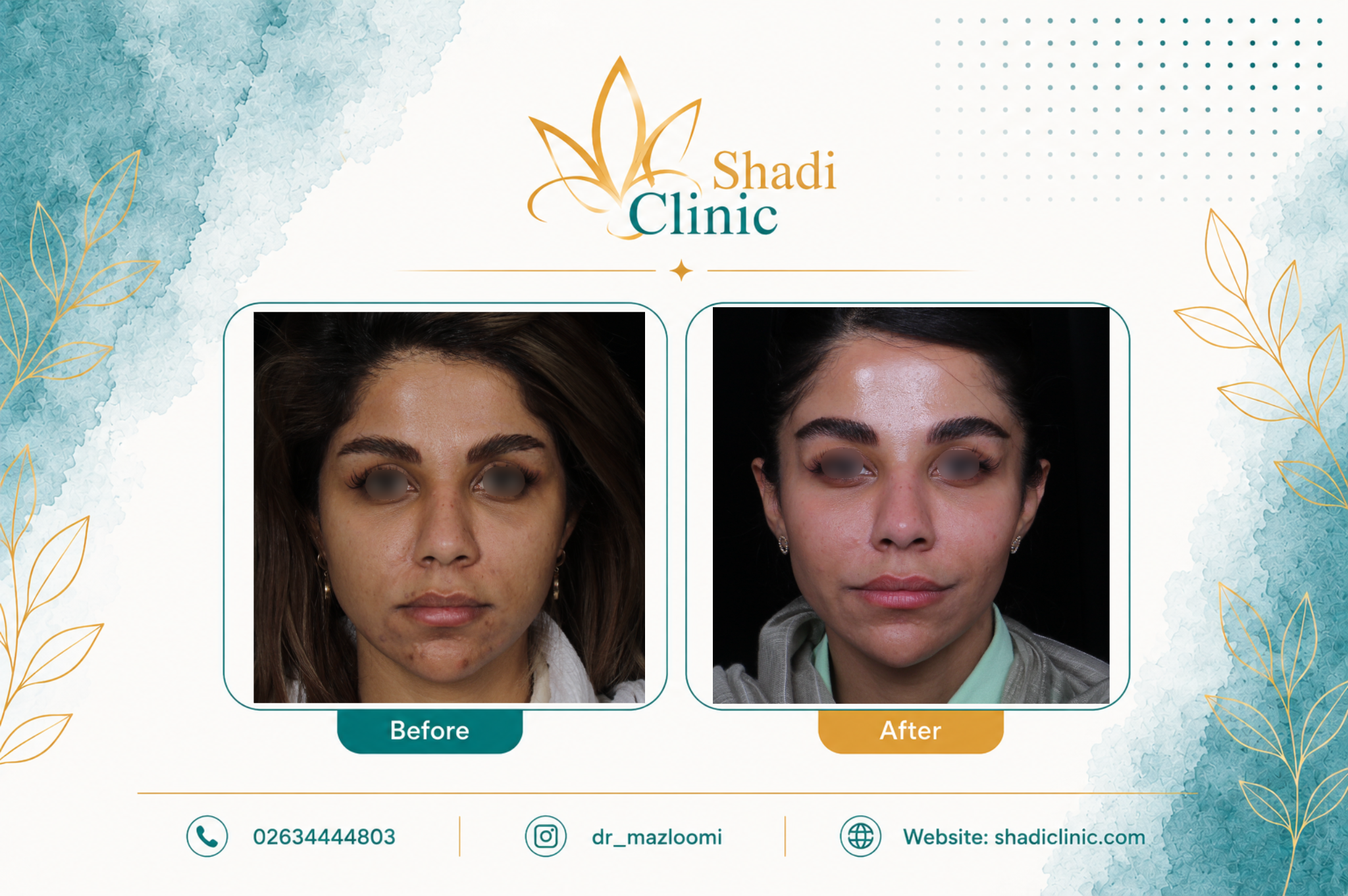 فرم دهی و زاویه سازی صورت با تکنیک MD CODE — کلینیک شادی کرج