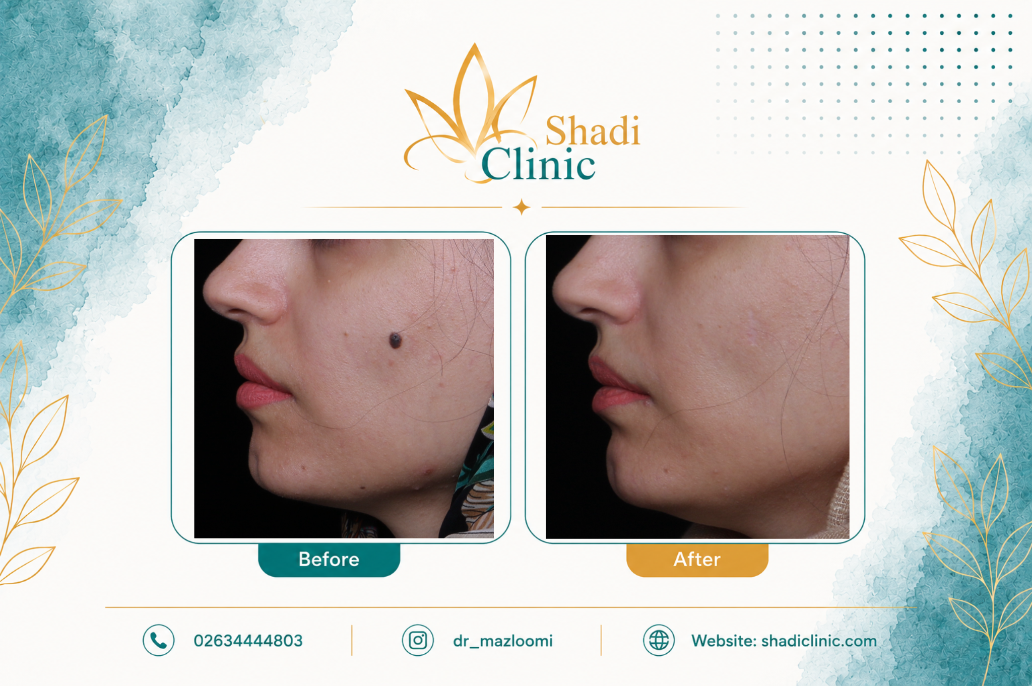 جراحی خال صورت — کلینیک شادی کرج