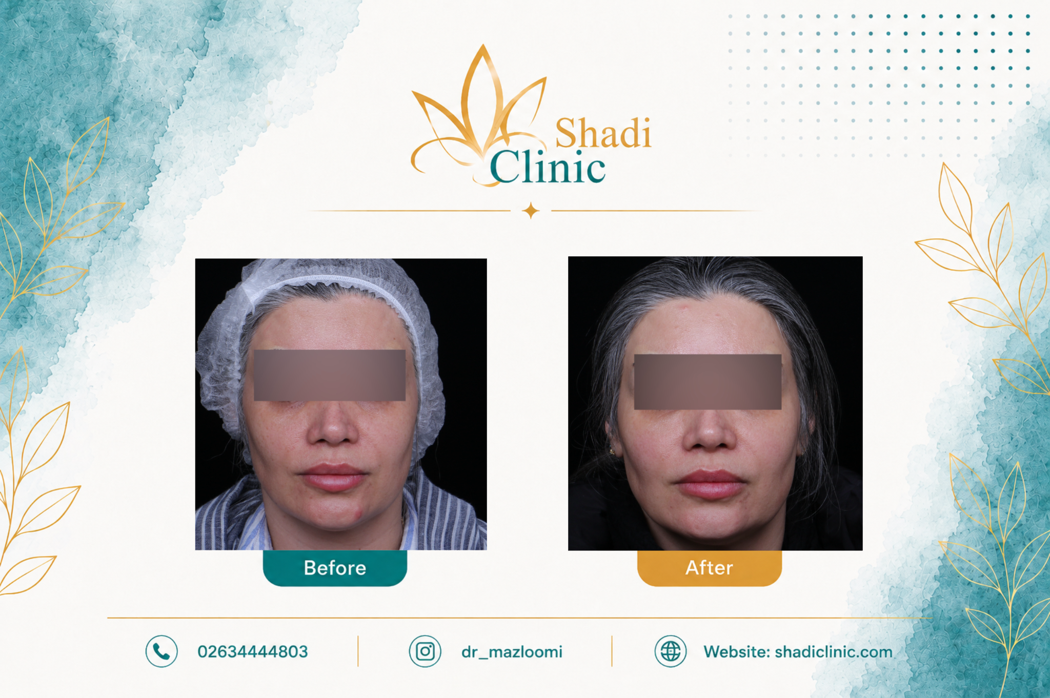 زاویه سازی و فرم دهی صورت با تکنیک MD CODE — کلینیک شادی کرج