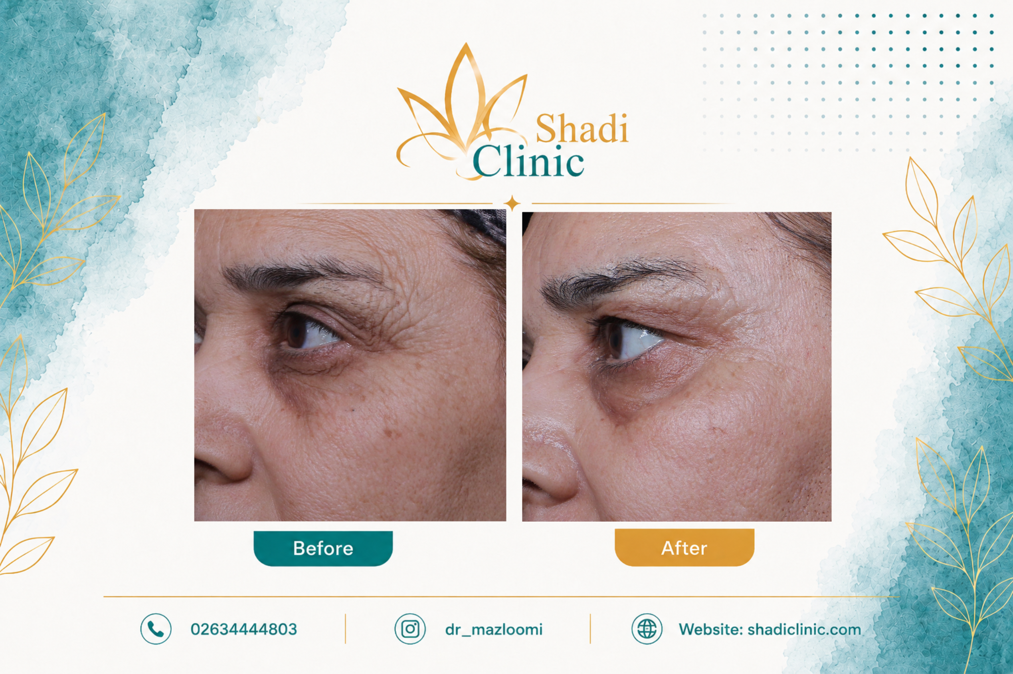 جوانسازی و رفع چین و چروک دور چشم با لیزر CO2 — کلینیک شادی کرج
