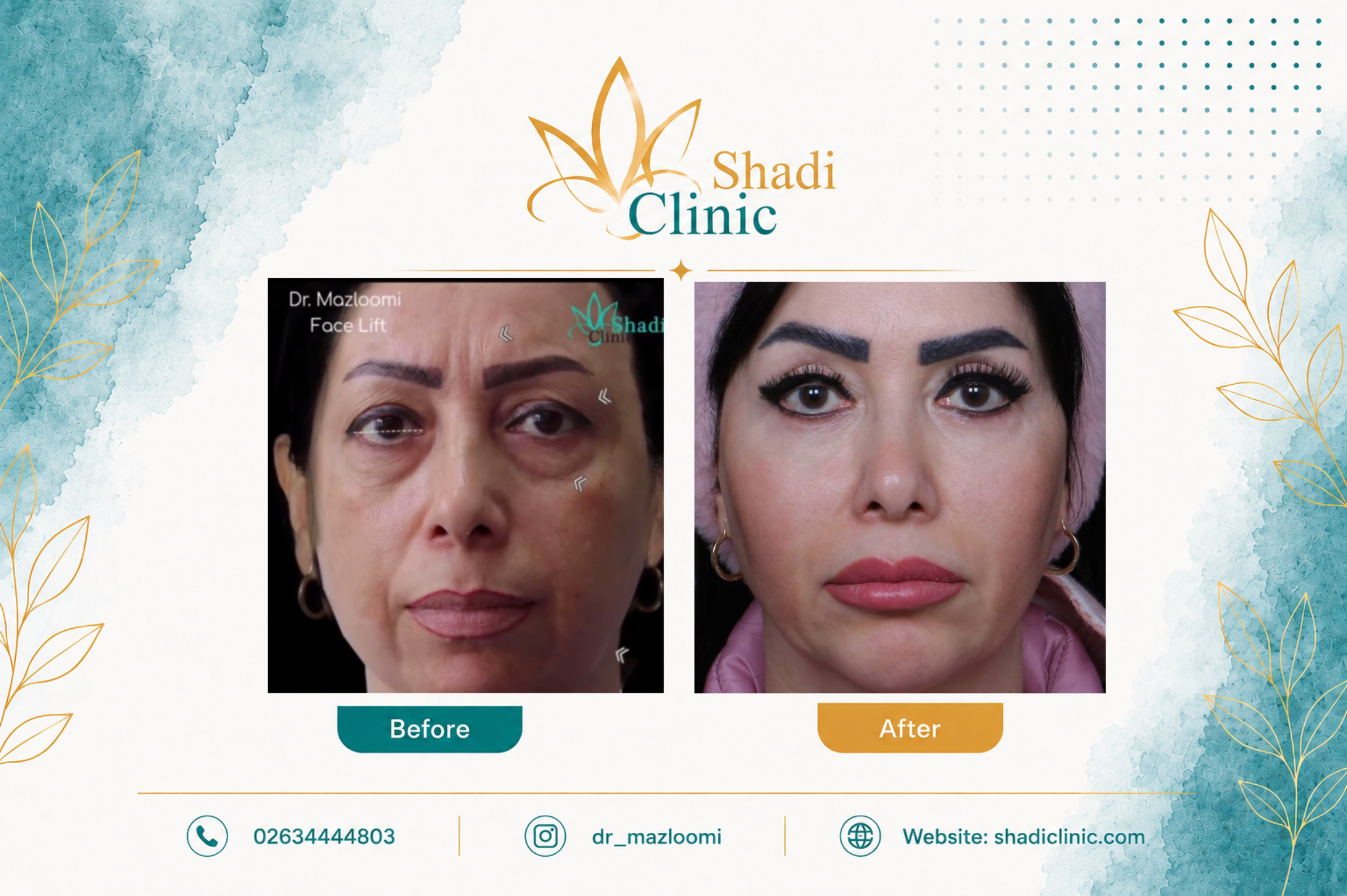 جوانسازی چندمرحله‌ای چهره با درمان‌های ترکیبی پوست، پلک و حجم‌دهی صورت — کلینیک شادی کرج