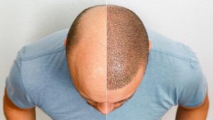 کاشت مو به روش fit